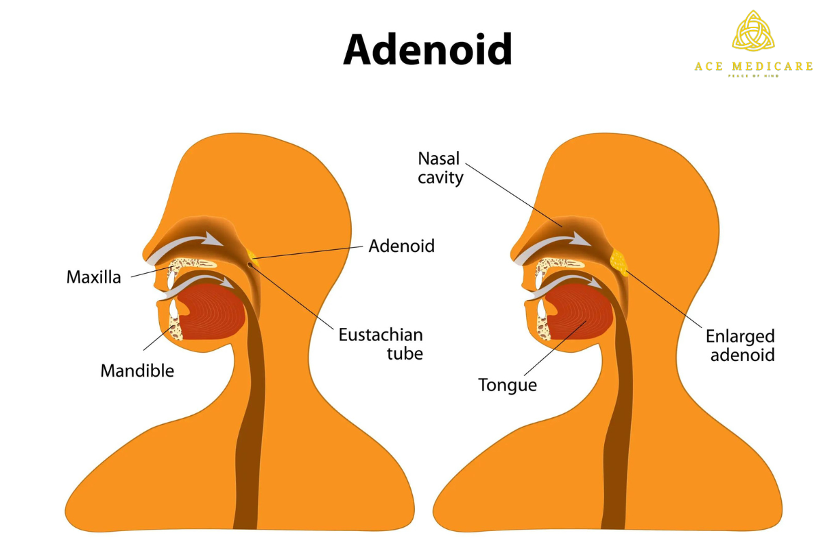 How Long Does Adenoiditis Last: Understanding the Duration of Adenoid Problems